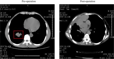 Genomic Feature of a Rare Case of Mix Small-Cell and Large-Cell Neuroendocrine Lung Carcinoma: A Case Report